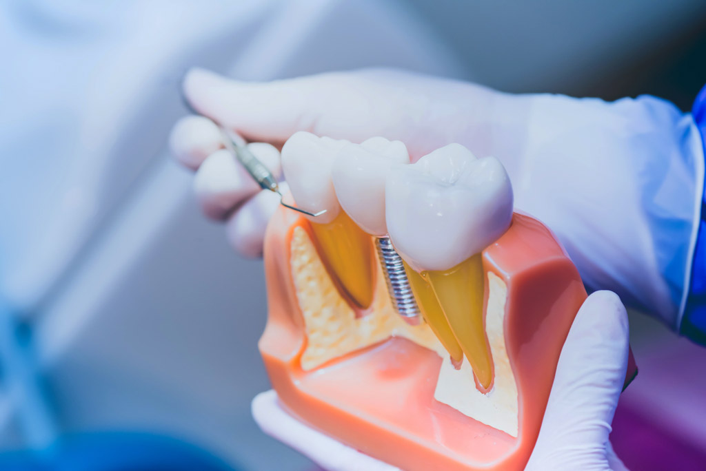 Implantes dentales en Sigüeiro