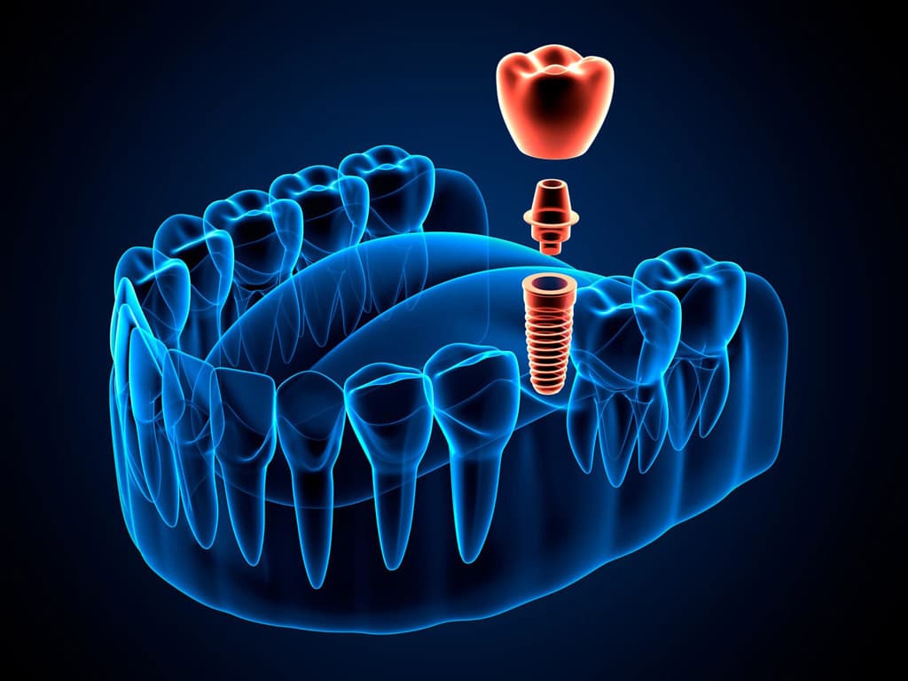 Implantes de dientes en Ortigueira