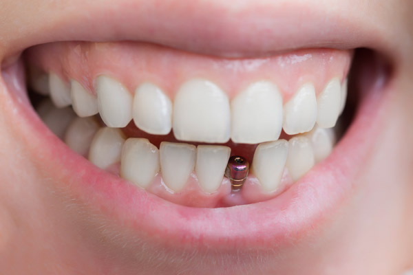 Implantes de dientes en Sigüeiro